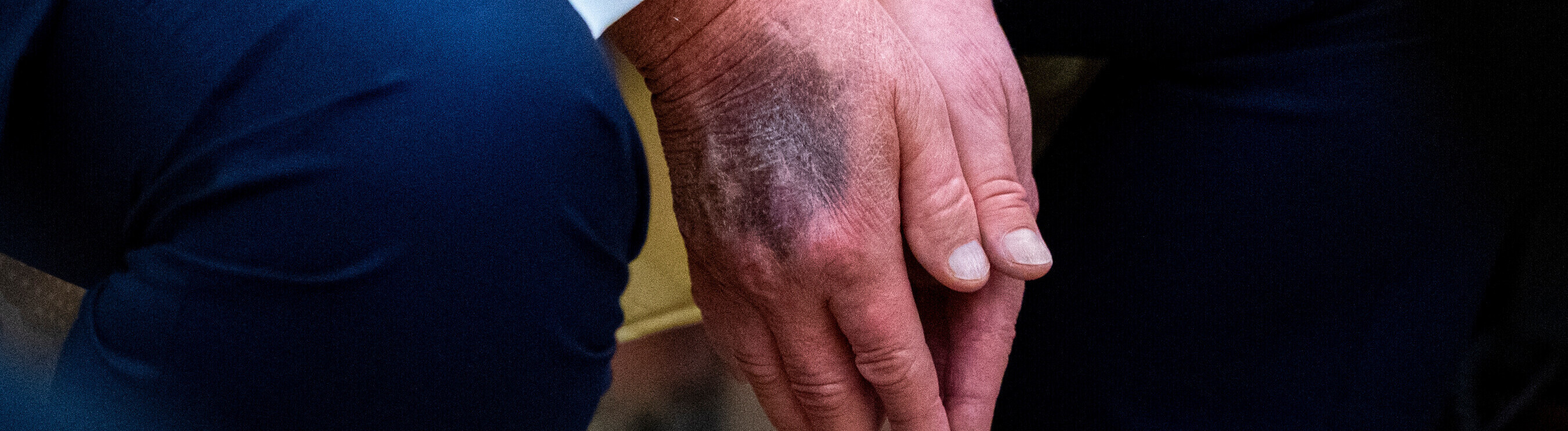 Nahaufnahme von Trumps Händen mit blauem Fleck
