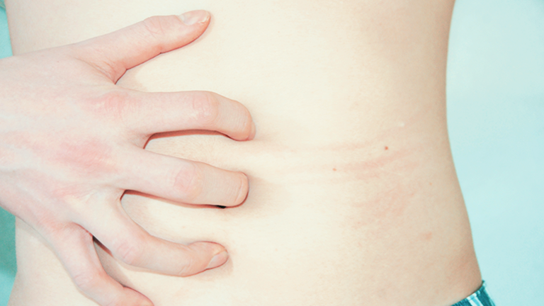 Eine Hand kratzt über einen nackten Bauch und hinterlässt rote Striemen.