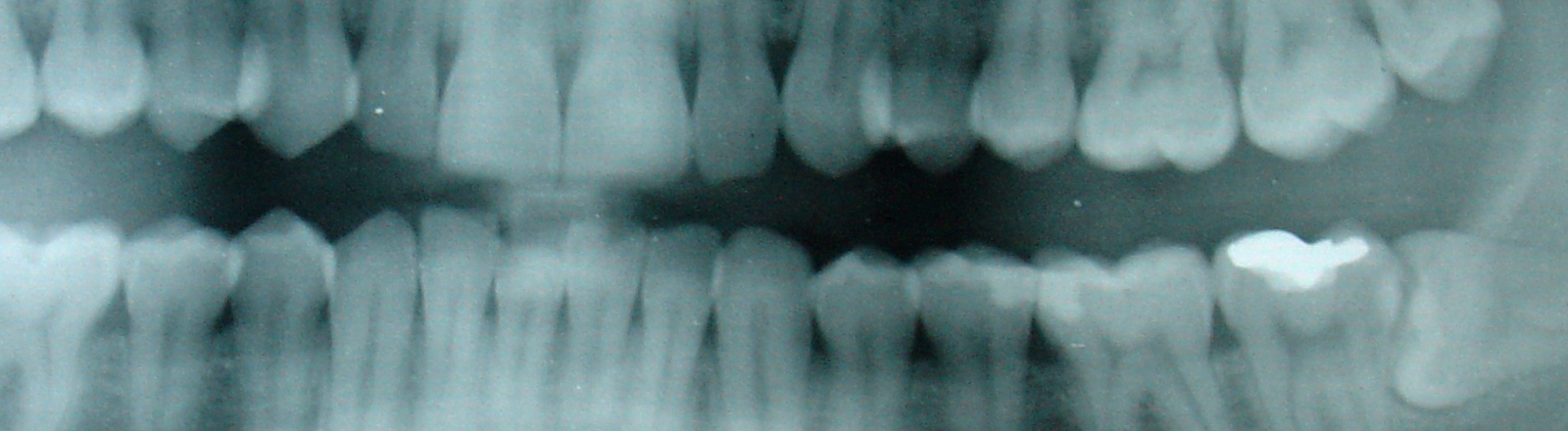 Eine geröntgte Zahnreihe mit Amalgam-Füllung.