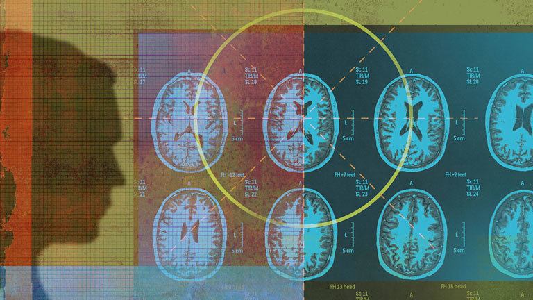 Collage Gehirnquerschnitte