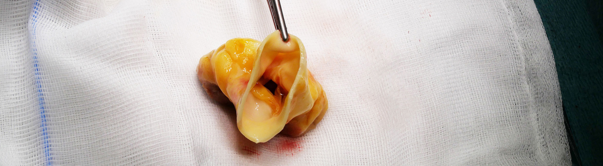 Eine Herzklappe, die gespendet wurde.