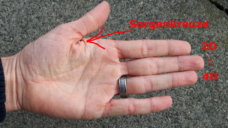 Stephan Beutings Hand mit Sorgeknoten und dem 2D:4D-Verhältnis