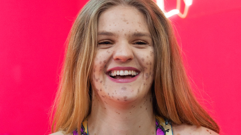 Junge Frau, die wegen einer Pigmentstörung viele Muttermale im Gesicht hat