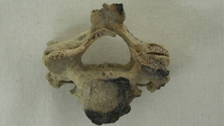 Knochen mit Verbrennungen