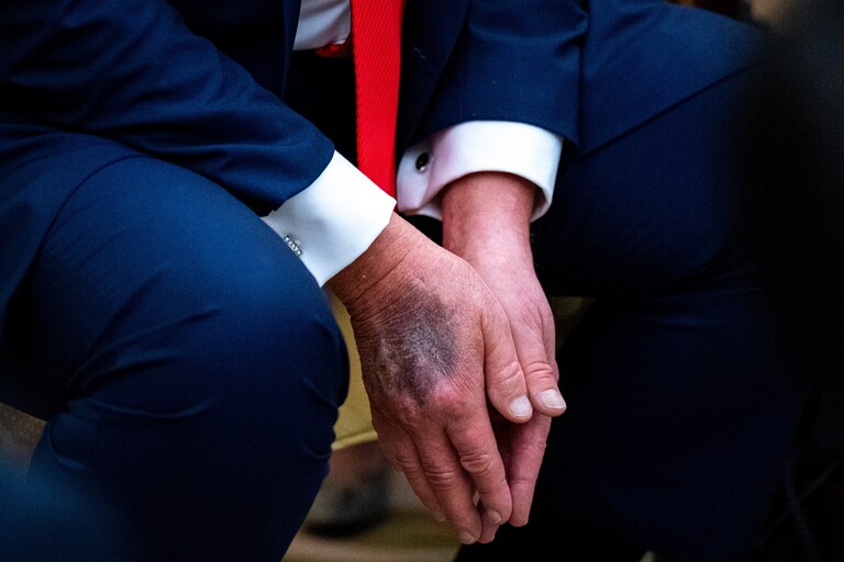 Ger-chte-um-Trumps-Gesundheit-Wie-geht-s-ihm-wirklich-