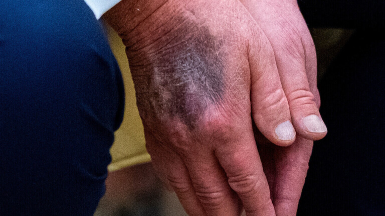 Nahaufnahme von Trumps Händen mit blauem Fleck