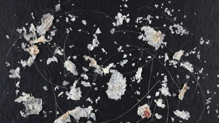 Die Schuppen eines älteren Mannes liegen zusammen mit einzelnen Haaren auf einer schwarzen Fläche.