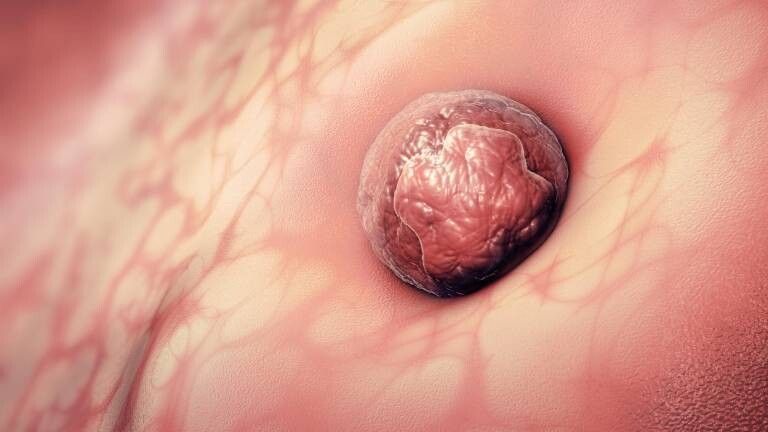 3D-Illustration einer befruchteten Eizelle, die sich in die Gebärmutter einnistet.