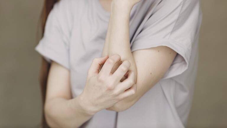 Eine Frau kratzt sich am Arm