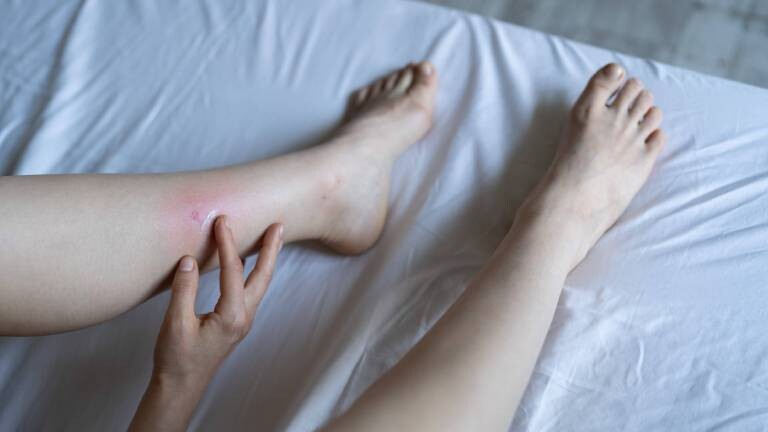 Eine Person liegt auf dem Bett und kratzt am Mückenstich (oberhalb des linken Knöchels).